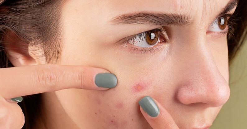 Acne Treatment - Woman Squeezing Her Pimples with Her Fingers